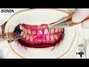 Dental Air Polisher